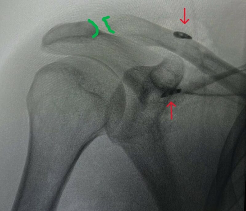 xra2a