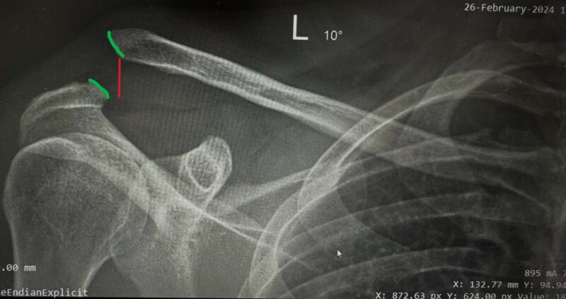 xray1a