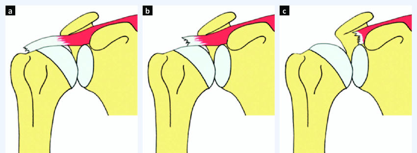 Patte-classification-of-full-thickness-rotator-cuff-tear-a-Stage-1-The-proximal-stump